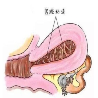 出现子宫粘连会不会怀不了孕？