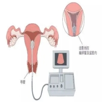 输卵管造影检查怎么做过程痛苦吗？