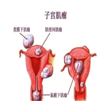 女性得了子宫肌瘤会不会影响生育能力？