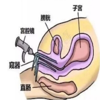 带你3分钟了解宫腔镜手术详细步骤？