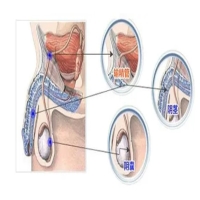 中医与手术克服输精管堵塞的有效方法