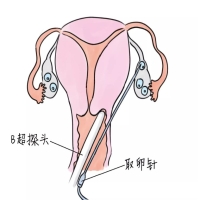 在泰国杰特宁取卵可以做无痛取卵吗？