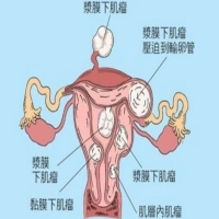 子宫肌瘤大小不同治疗方案是一样的吗？