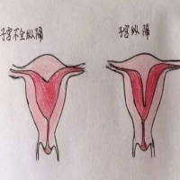 有纵隔子宫怎么办还能正常怀孕吗？