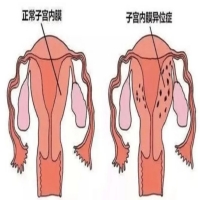 解密子宫内膜异位症：深入了解病因与治疗