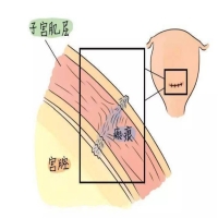 宫腔有疤痕化能做试管婴儿吗？