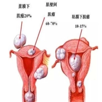 笙宝带你了解子宫肌瘤如何影响月经周期？