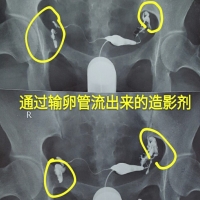 3分钟了解输卵管造影的意义与检查过程