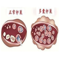 多囊卵巢综合症与内分泌失调之间关系大吗？