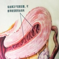 子宫轻微粘连会影响怀孕吗？