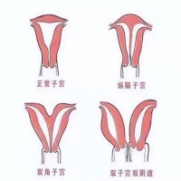 纵隔子宫的探秘：孕育过程中的隐忧与科学突破