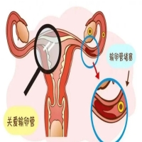 没生过孩子也会出现输卵管堵塞的情况吗？