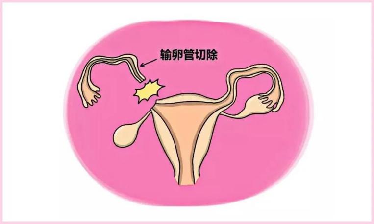 输卵管切除，泰国试管婴儿一次成功怀孕