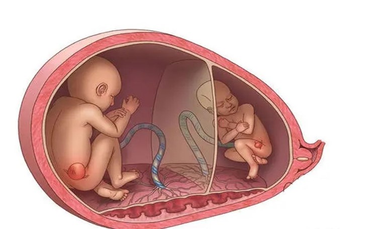 试管婴儿是否会增加多胞胎的风险？