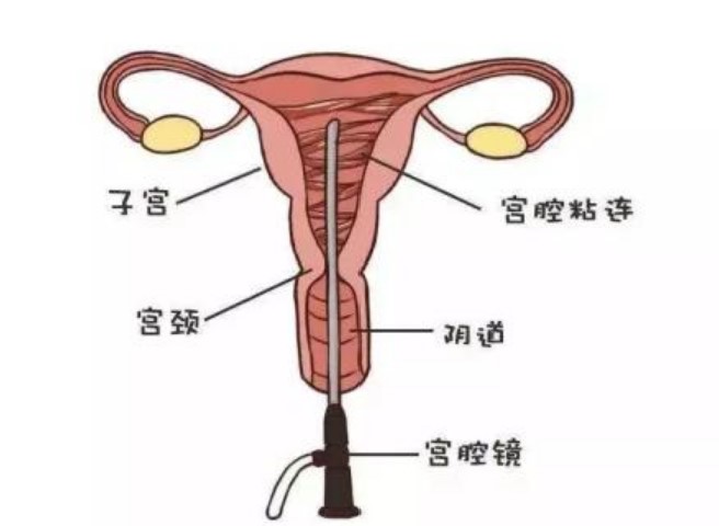 宫腔粘连最快怀孕方法