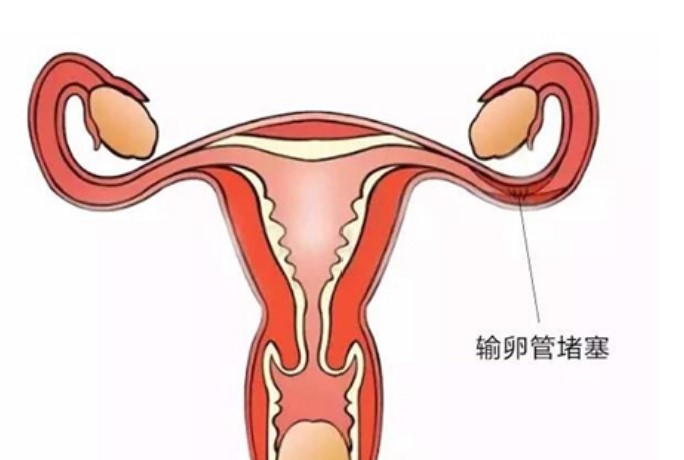 输卵管堵塞是否会复发？如何预防？