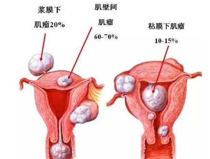 笙宝带你了解子宫肌瘤如何影响月经周期